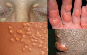 XANTHOMA contraindications In beauty therapy