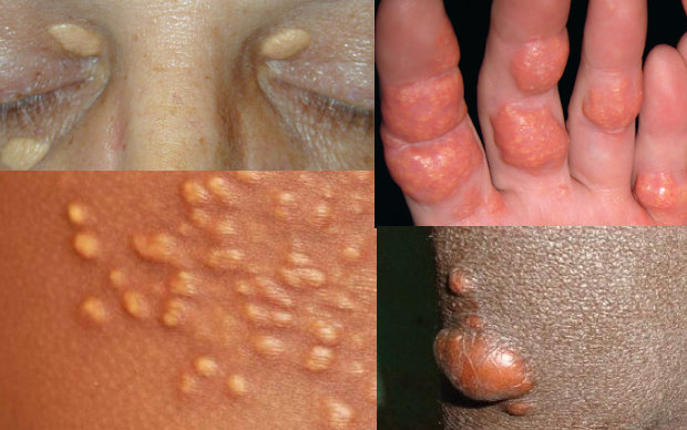 XANTHOMA contraindications In beauty therapy