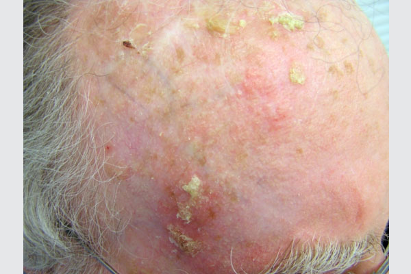 ACTINIC KERATOSIS contraindications In beauty therapy