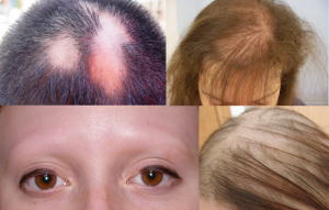 ALOPECIA contraindications In beauty therapy