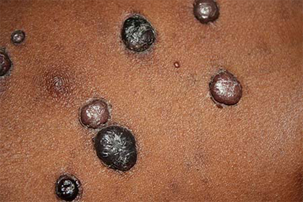 BACILLARY ANGIOMATOSIS contraindications In beauty therapy