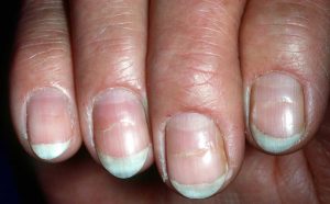 BEAU’S LINE contraindications In beauty therapy