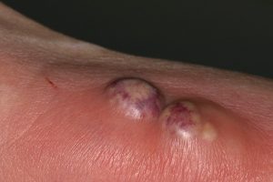 BOIL AND FURUNCLE (FURUNCLE) contraindications In beauty therapy