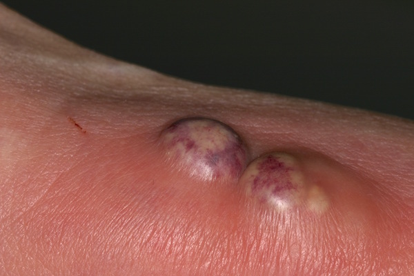 BOIL AND FURUNCLE (FURUNCLE) contraindications In beauty therapy