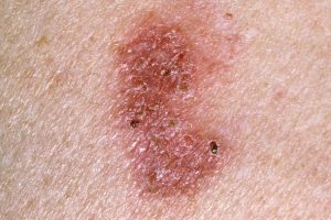 BOWEN’S DISEASE contraindications In beauty therapy