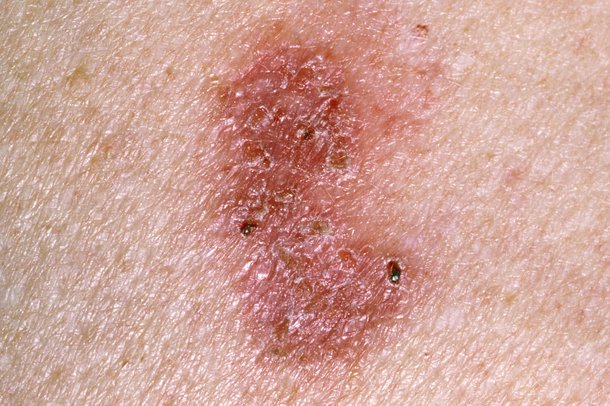 BOWEN’S DISEASE contraindications In beauty therapy