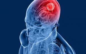 BRAIN TUMOURS contraindications In beauty therapy