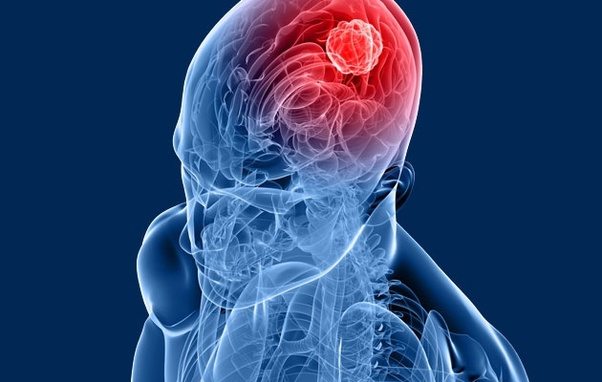 BRAIN TUMOURS contraindications In beauty therapy