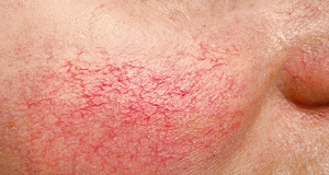 BROKEN CAPILLARIES contraindications In beauty therapy
