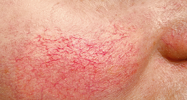 BROKEN CAPILLARIES contraindications In beauty therapy