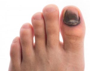 BRUISED NAILS contraindications In beauty therapy