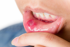 Behcet's disease contraindications In beauty therapy