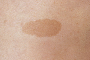 CAFÉ AU LAIT MACULE contraindications In beauty therapy