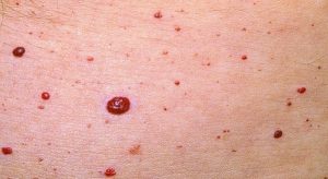 CAMPBELL DE MORGAN SPOTS (CHERRY ANGIOMAS) contraindications In beauty therapy