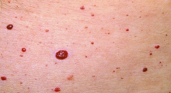 CAMPBELL DE MORGAN SPOTS (CHERRY ANGIOMAS) contraindications In beauty therapy