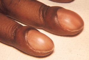 CLUBBING NAILS contraindications In beauty therapy