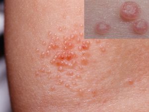 CONTAGIOSUM EPITHELIALE (MOLLUSCUM CONTAGIOSUM) contraindications In beauty therapy
