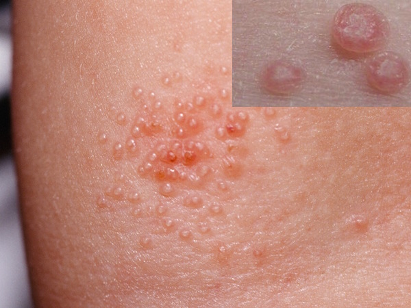 CONTAGIOSUM EPITHELIALE (MOLLUSCUM CONTAGIOSUM) contraindications In beauty therapy