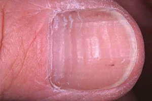 CORRUGATIONS (WAVY RIDGES) contraindications In beauty therapy