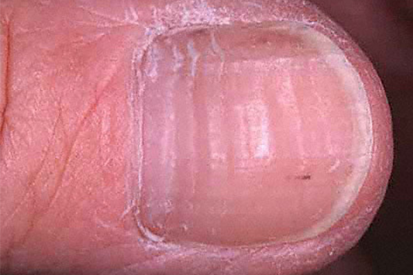 CORRUGATIONS (WAVY RIDGES) contraindications In beauty therapy