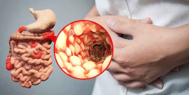 CROHN’S DISEASE contraindications In beauty therapy