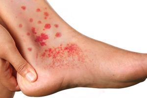 CRYOGLOBULINEMIA contraindications In beauty therapy