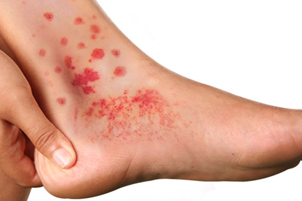 CRYOGLOBULINEMIA contraindications In beauty therapy