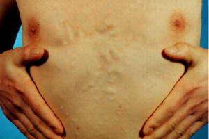 CYSTICERCOSIS contraindications In beauty therapy