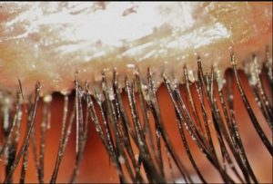 DEMODEX FOLLICULORUM contraindications In beauty therapy