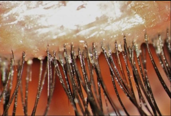 DEMODEX FOLLICULORUM contraindications In beauty therapy