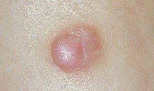 DERMATOFIBROMA contraindications In beauty therapy