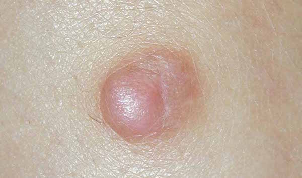 DERMATOFIBROMA contraindications In beauty therapy
