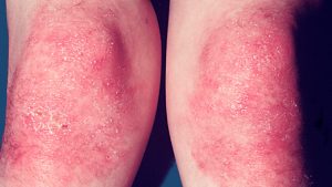 DERMATOMYOSITIS contraindications In beauty therapy