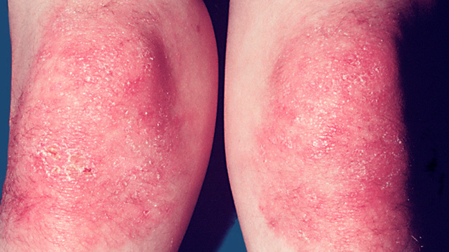 DERMATOMYOSITIS contraindications In beauty therapy