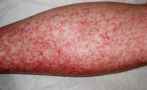 DRUG ERUPTION contraindications In beauty therapy