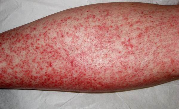 DRUG ERUPTION contraindications In beauty therapy