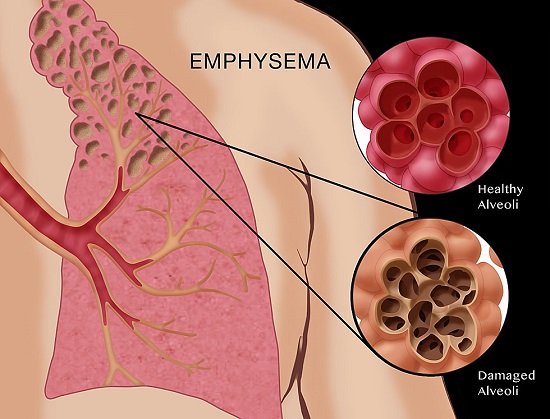 EMPHYSEMA contraindications In beauty therapy