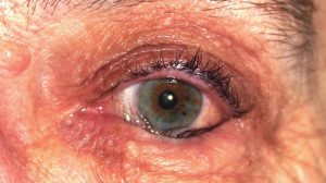 ENTROPION contraindications In beauty therapy