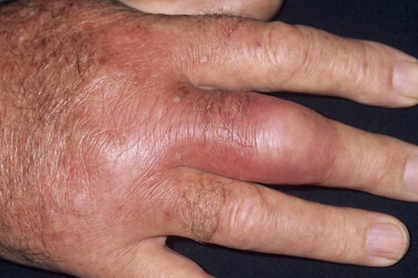 ERYSIPELAS contraindications In beauty therapy