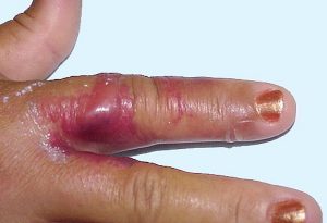ERYSIPELOID contraindications In beauty therapy