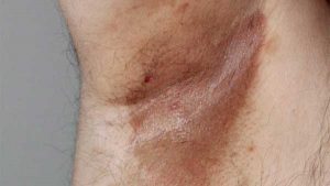 ERYTHRASMA contraindications In beauty therapy