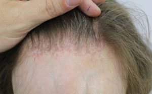 FRONTAL FIBROSING ALOPECIA contraindications In beauty therapy