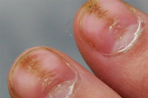 HABIT TIC contraindications In beauty therapy