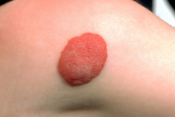 HAEMANGIOMA contraindications In beauty therapy