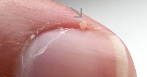 HANGNAIL contraindications In beauty therapy