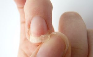 EGGSHELL NAILS (HAPALONYCHIA) contraindications In beauty therapy
