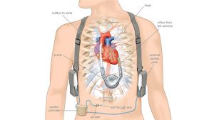 HEART FAILURE contraindications In beauty therapy