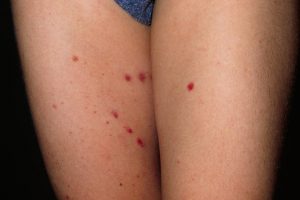 HENOCH-SCHÖNLEIN PURPURA (VASCULAR PURPURA) contraindications In beauty therapy