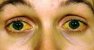 HEPATITIS contraindications In beauty therapy