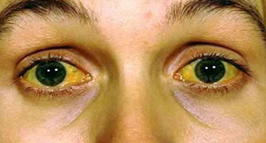 HEPATITIS contraindications In beauty therapy